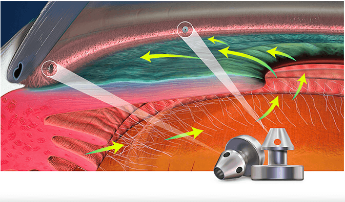 Cirugía Mínimamente Invasiva para el Glaucoma en Madrid