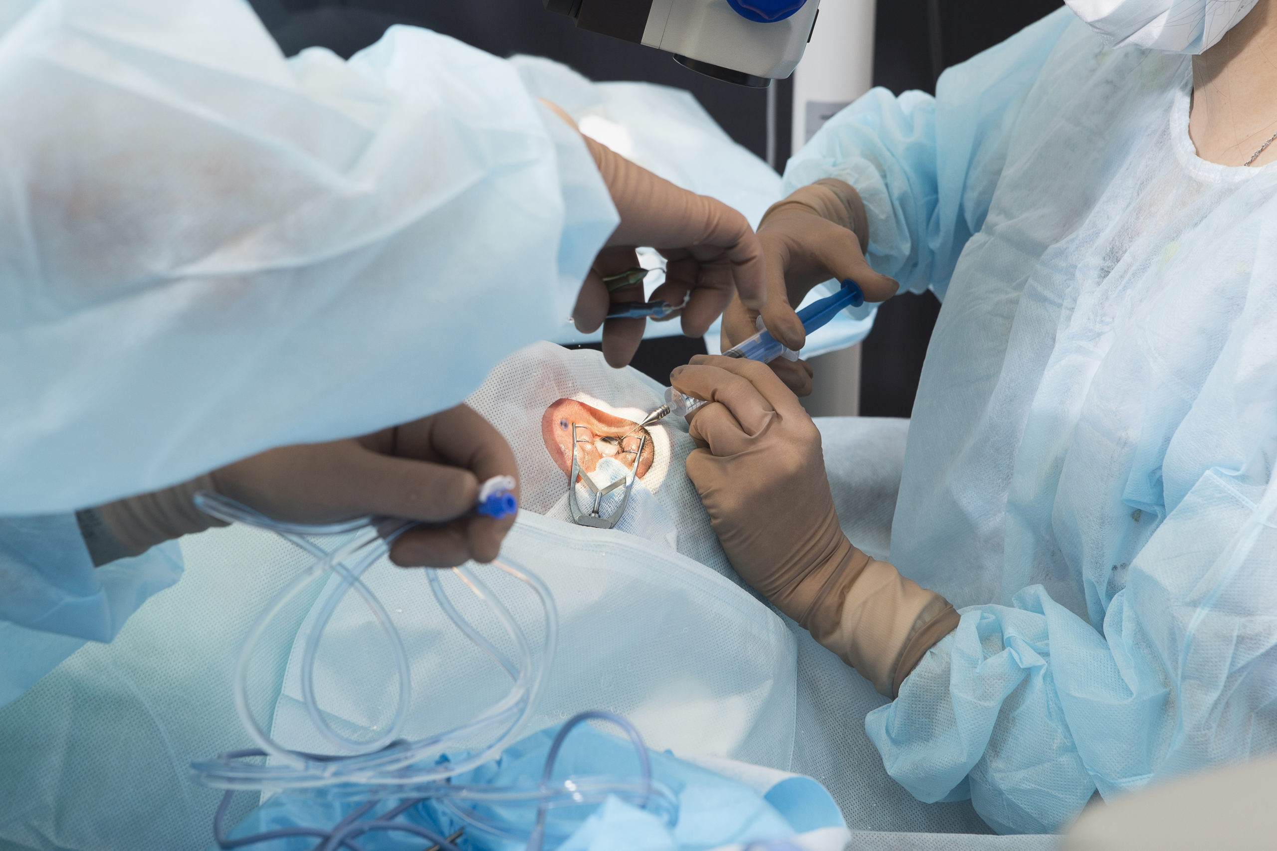 Cirugía de cataratas mediante facoemulsificación realizada por un equipo oftalmológico en quirófano