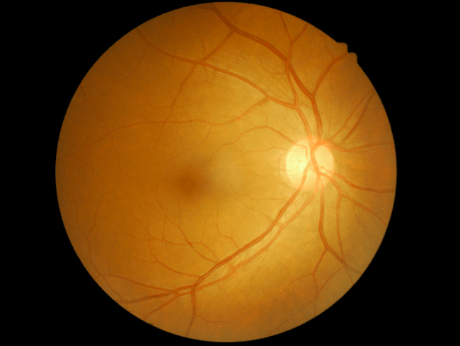 Realización de una OCT del nervio óptico, prueba indolora y no invasiva para el diagnóstico del glaucoma